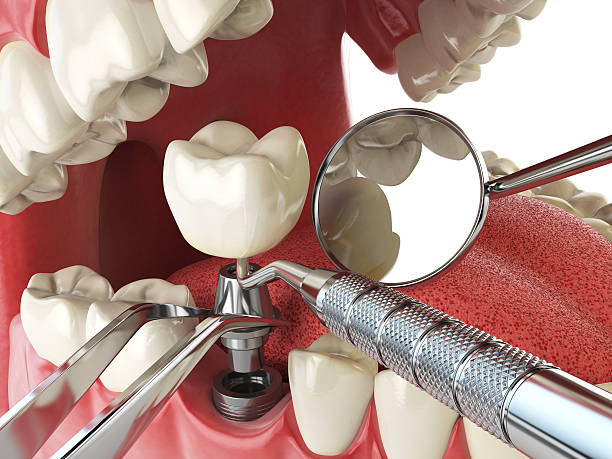 Best Lost Filling or Crown Replacement in Rosewood Heights, IL